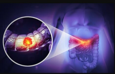 Onkologu paralajmëron për një simptomë të nënvlerësuar të kancerit të zorrës, ndërsa rastet te të rinjtë po rriten ndjeshëm